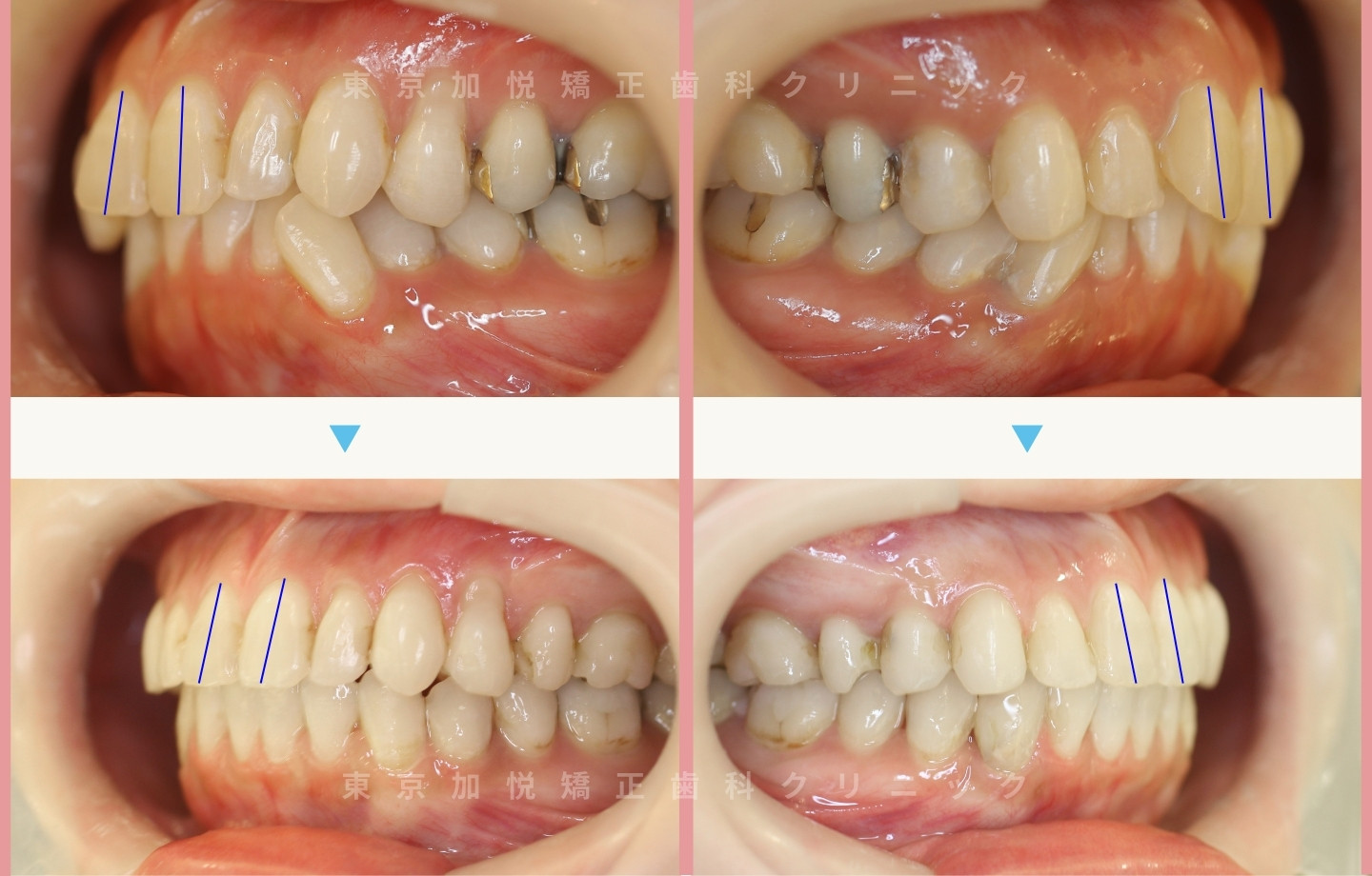 抜歯をせずに歯科矯正の治療前後写真(全顎矯正)