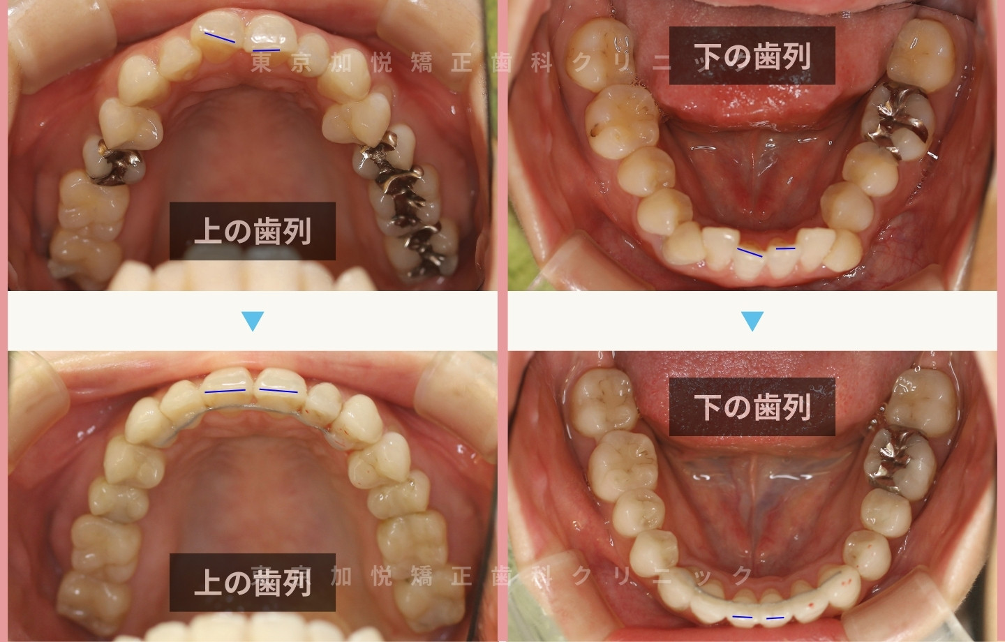 抜歯をせずに歯科矯正の治療前後写真(全顎矯正)