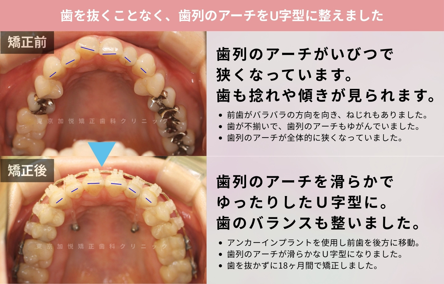 抜歯をせずに歯科矯正の治療前後写真(全顎矯正)