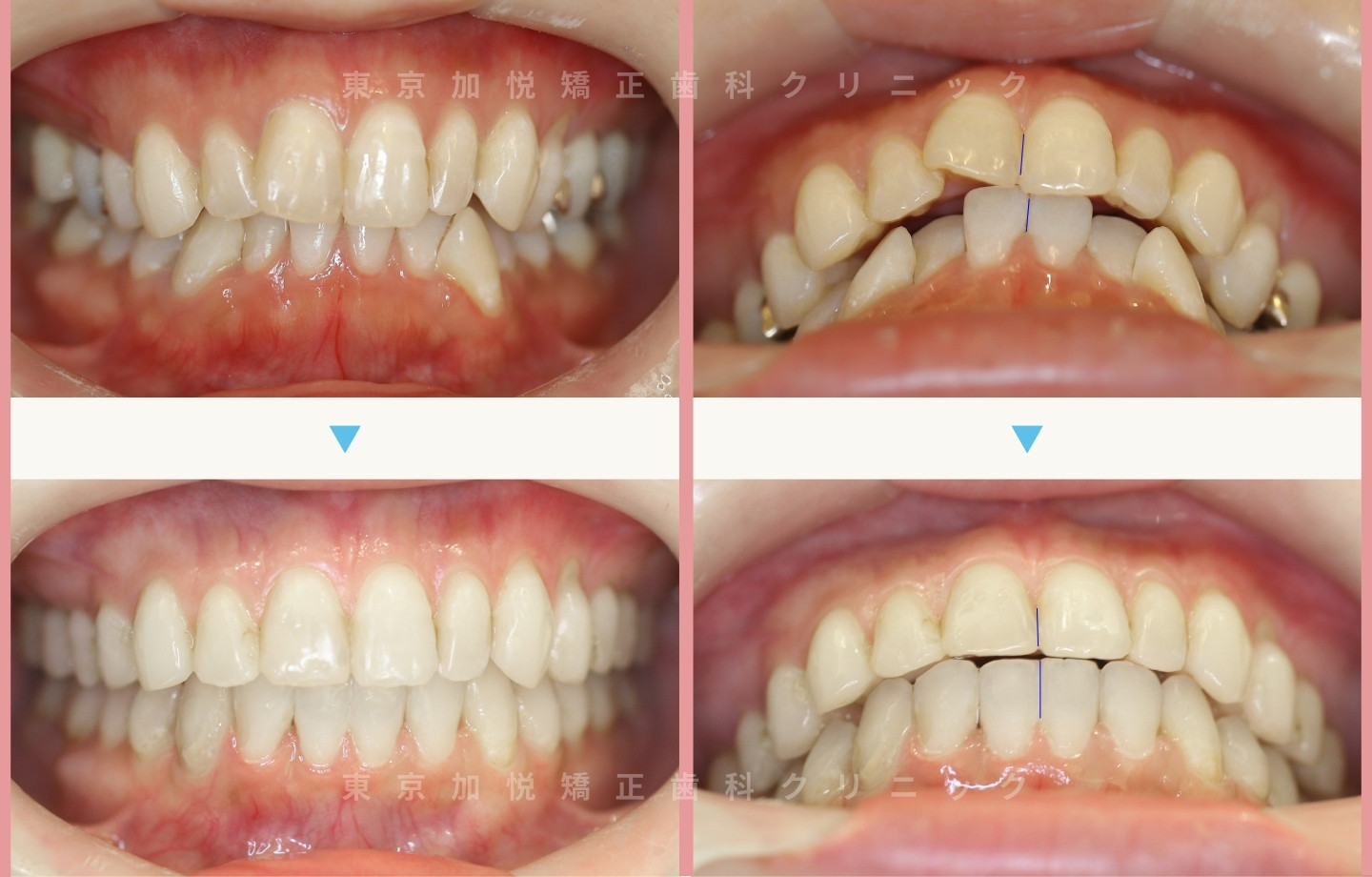 抜歯をせずに歯科矯正の治療前後写真(全顎矯正)
