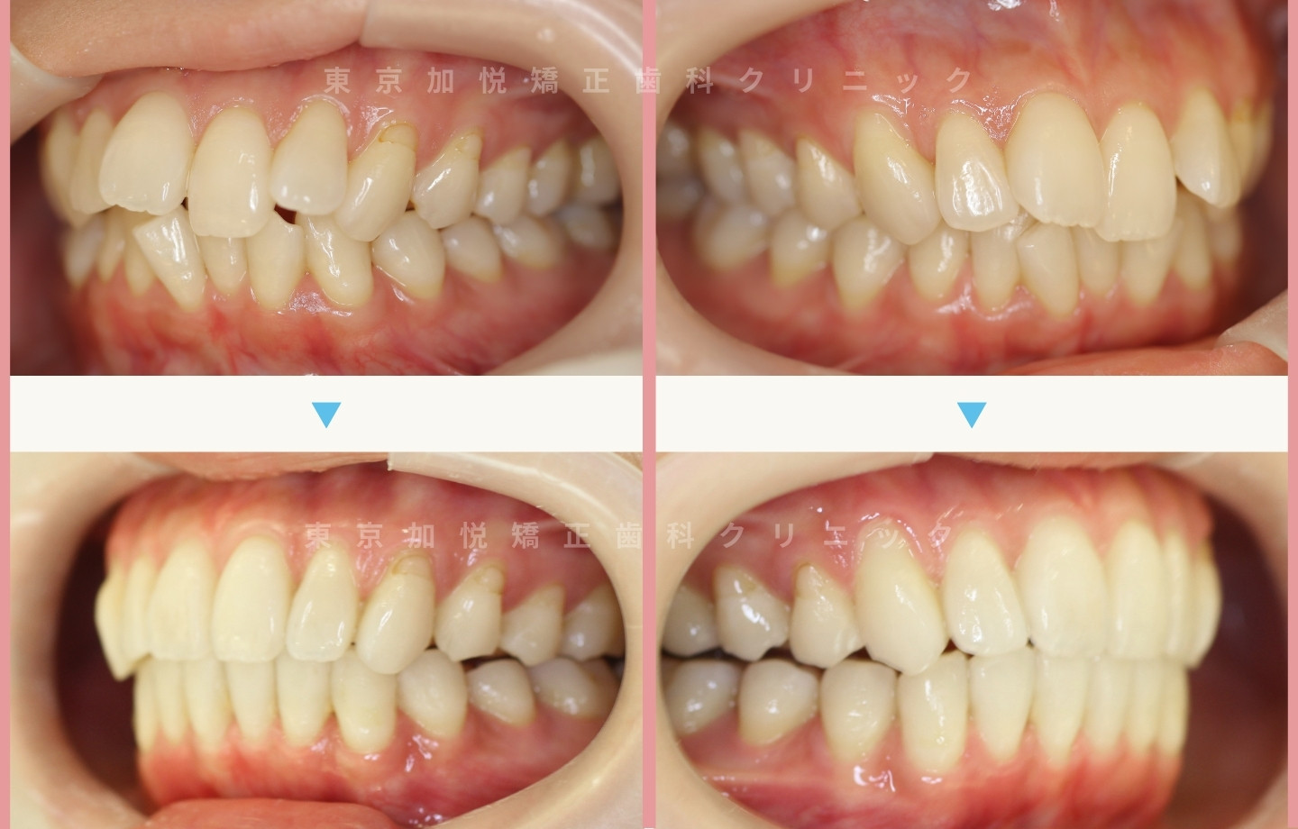 抜歯をせずに歯科矯正の治療前後写真(上下前歯のみ歯科矯正)