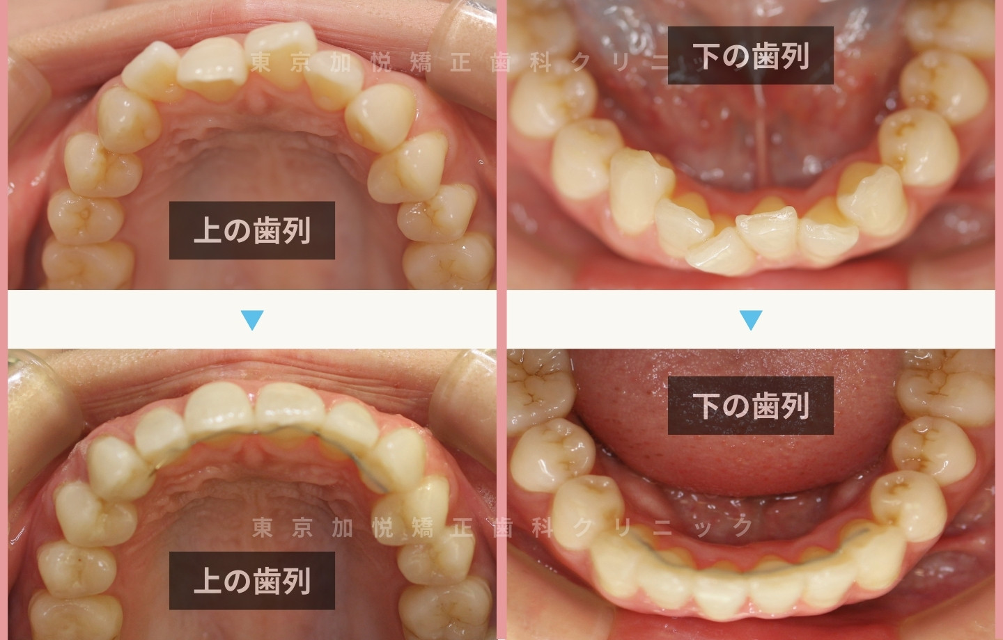 抜歯をせずに歯科矯正の治療前後写真(上下前歯のみ歯科矯正)