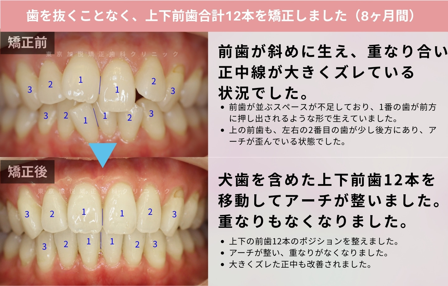 抜歯をせずに歯科矯正の治療前後写真(上下前歯のみ歯科矯正)