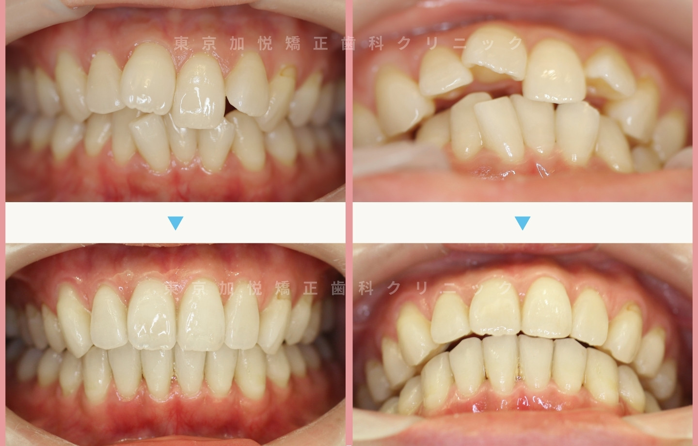 抜歯をせずに歯科矯正の治療前後写真(上下前歯のみ歯科矯正)