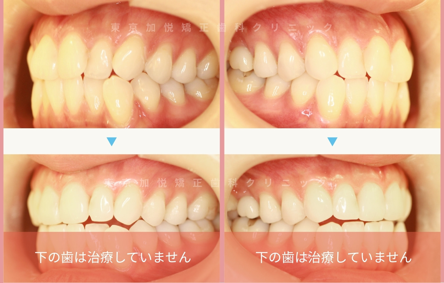 抜歯をせずに歯科矯正の治療前後写真(上前歯のみ歯科矯正)