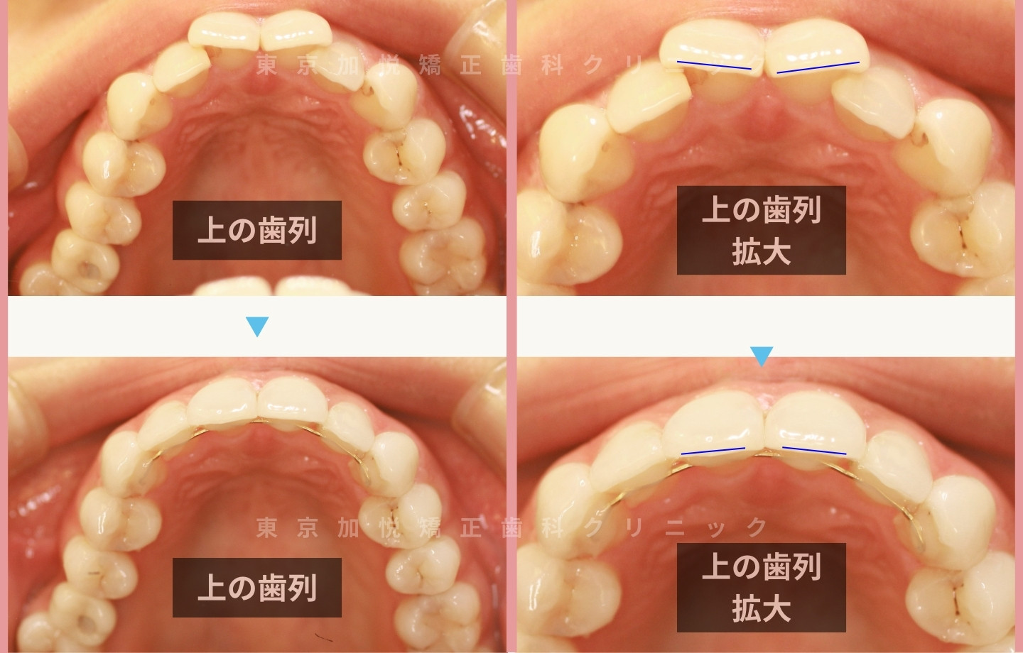 抜歯をせずに歯科矯正の治療前後写真(上前歯のみ歯科矯正)