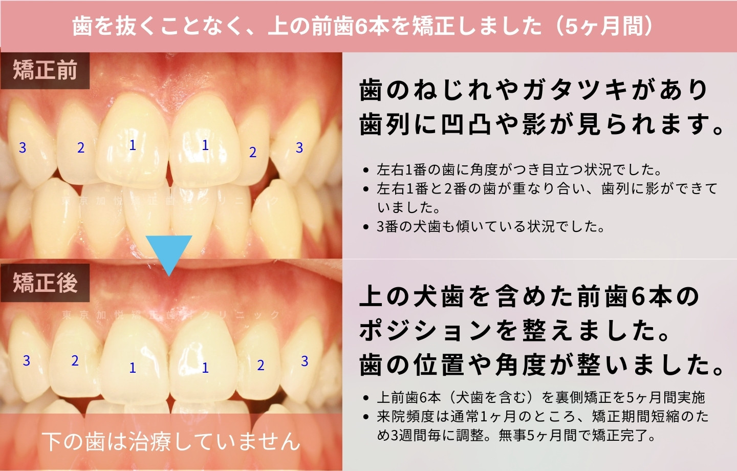 抜歯をせずに歯科矯正の治療前後写真(上前歯のみ歯科矯正)