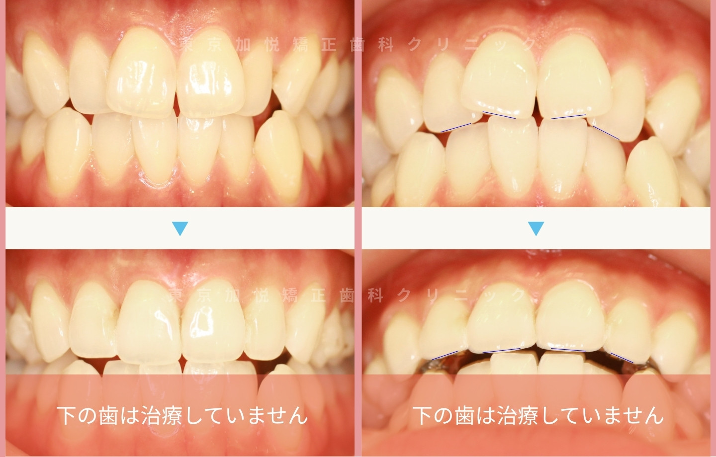 抜歯をせずに歯科矯正の治療前後写真(上前歯のみ歯科矯正)